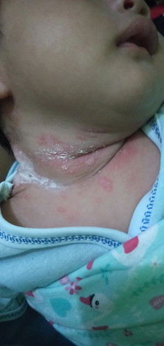 Bentol merah di leher bayi