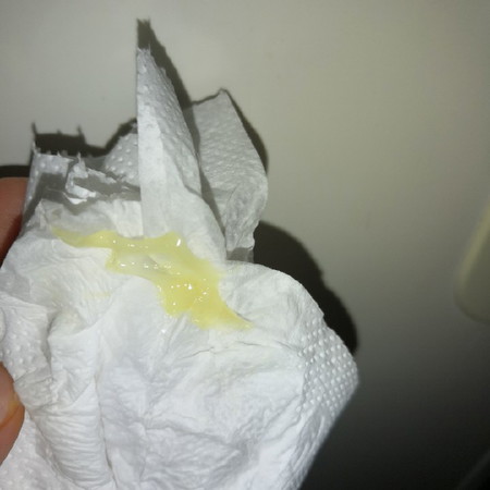 Mucus Plug