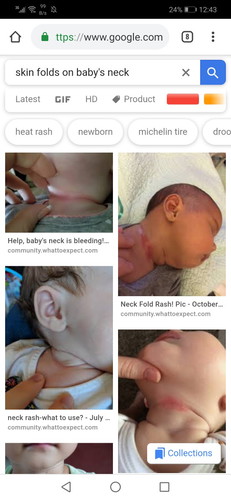 DROOL RASH/SKIN FOLDS OF NEWBORN