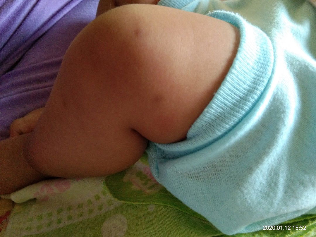 bekas gigitan nyamuk