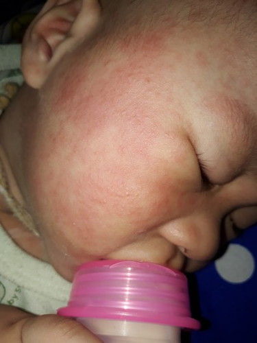 แม่ๆค่ะ มีลูกๆบ้านไหนเป็นแบบนี้บางไหมค่ะ