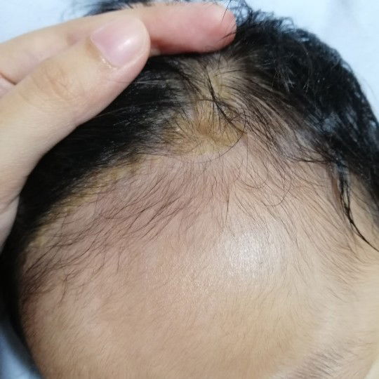 Dandruff?
