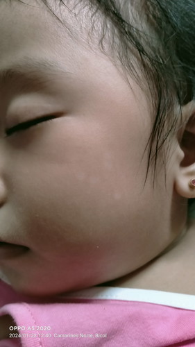 Ma white patch po s face ni baby ko 1 trans 4m na po xa matatanggal din po kaya ito anu po kaya gam
