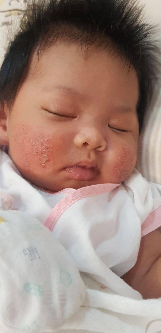 น้องมีผื่นขึ้นที่แก้ม
