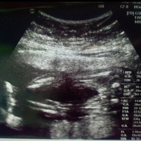 20 week