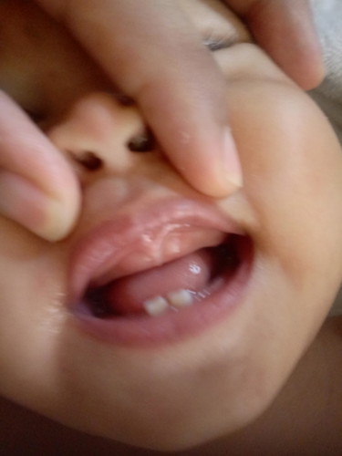 8-10x poop ng lo kong teething