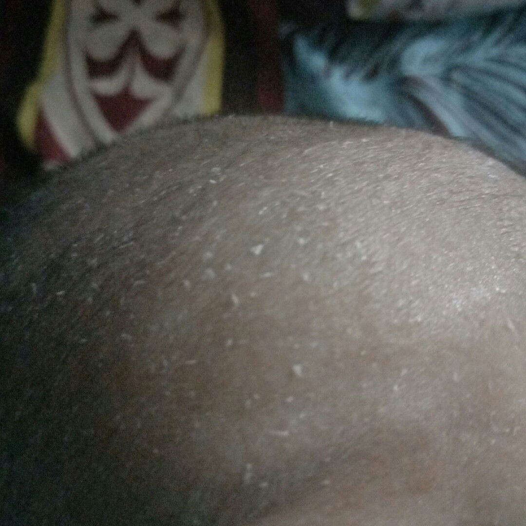 Kulit Kepala Mengelupas dan Kering