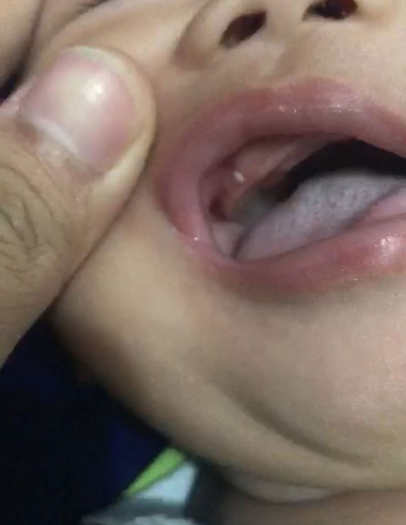 Bintik putih di gusi bayi