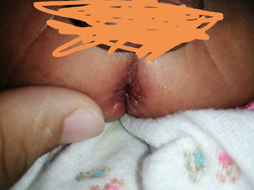 ก้นเปื่อย