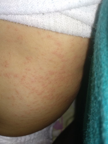 cara menghilangkan biang keringat