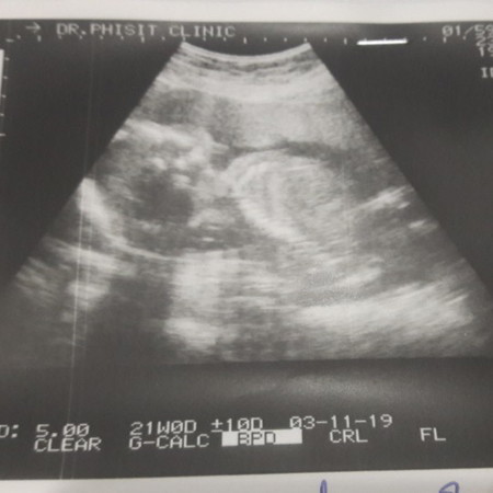 อยากรู้เพศของลูก