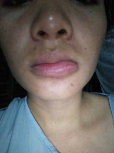 คุณแม่ท่านไหนโดนแตนต่อยบางค่ะ