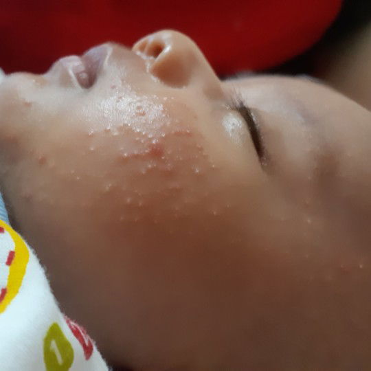jerawat bayi