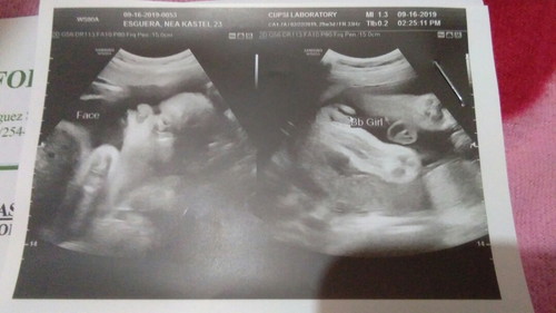 ultrasound pelvis and gender reveal.. ??