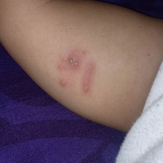 penyakit kulit pada bayi....