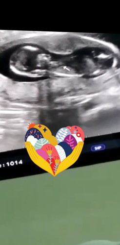 Flek 13 Week