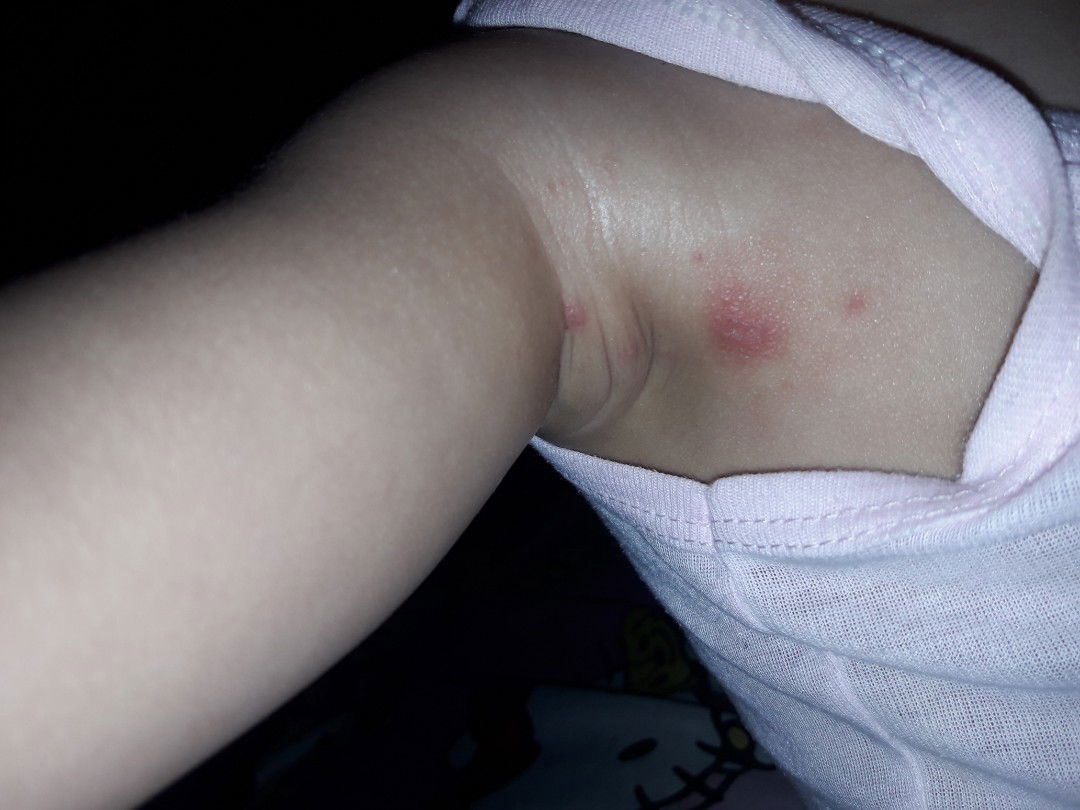 bun apakah ini herpes