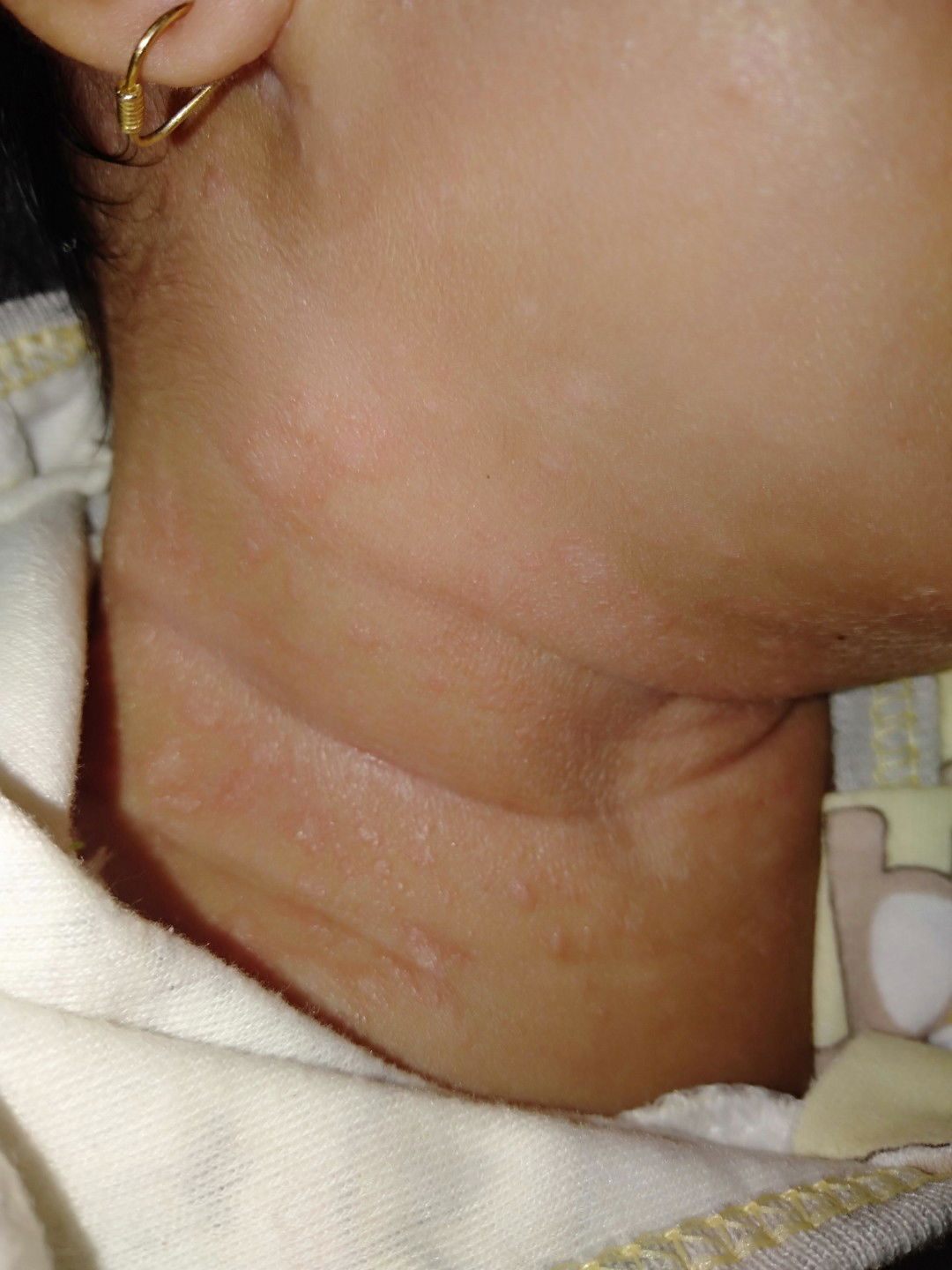 Lactacyd Baby Bisa Menghilangkan Ruam Akibat Sensitiv Sabun Tertentu&Terkena ASI ?