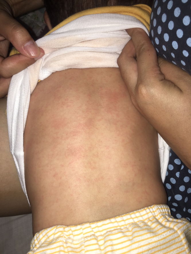 Bercak merah di kulit