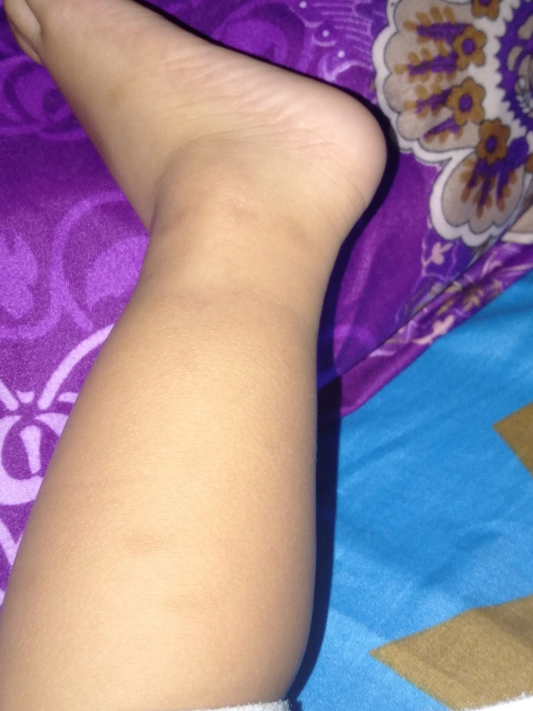 bekas gigitan semut merah dn nyamuk