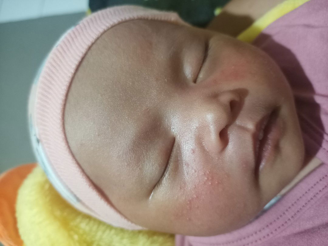 Beruntusan pada bayi