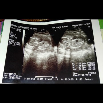 Hasil USG