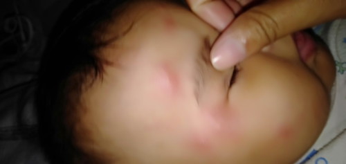 kagat ng lamok