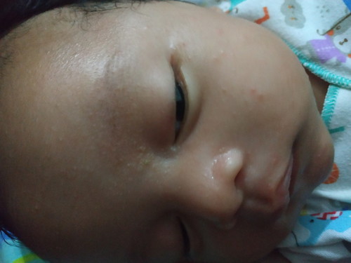 bintik2 kyak jerawat