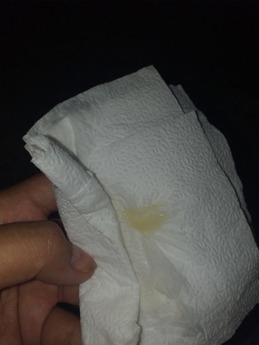 มีแบบนี้เหมือนตกขาว แต่อันนี้มันเหนียวๆยืดๆ