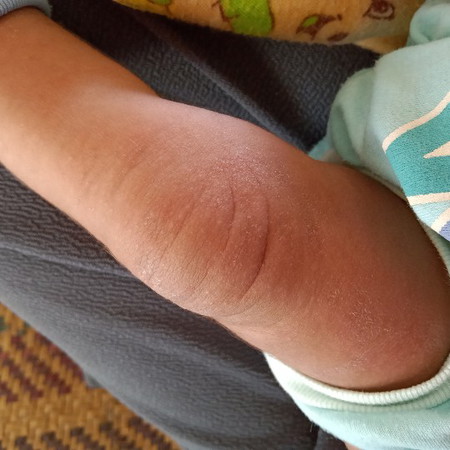 kulit bayi kering