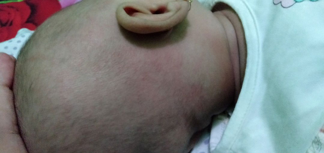 biang keringat di kepala