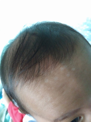 ใครมีวิธีรักษาเกลื้อนน้ำนม หรือ กลากน้ำนมบ้างคะ