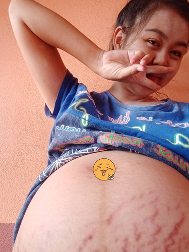 ท้องลายกันไหมคะคุณแม่ๆ