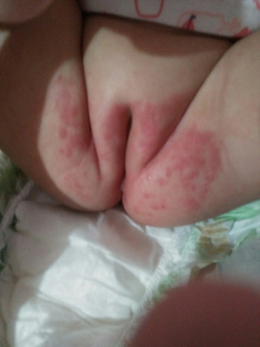 Diaper Rash