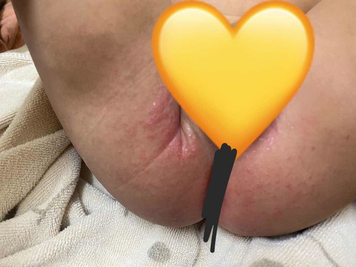 Nappy rash / ruam lampin