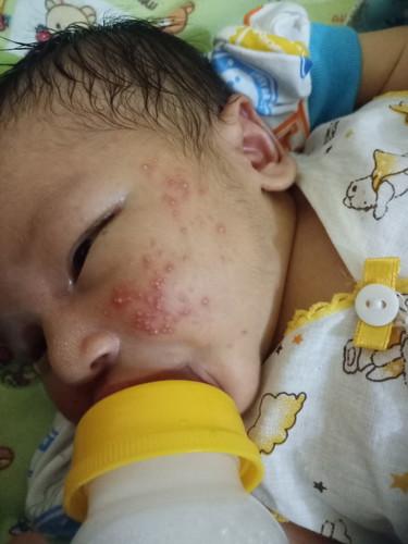 merah di pipi bayi