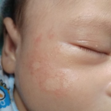 ruam susu