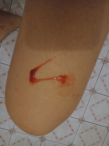 มูกเลือด