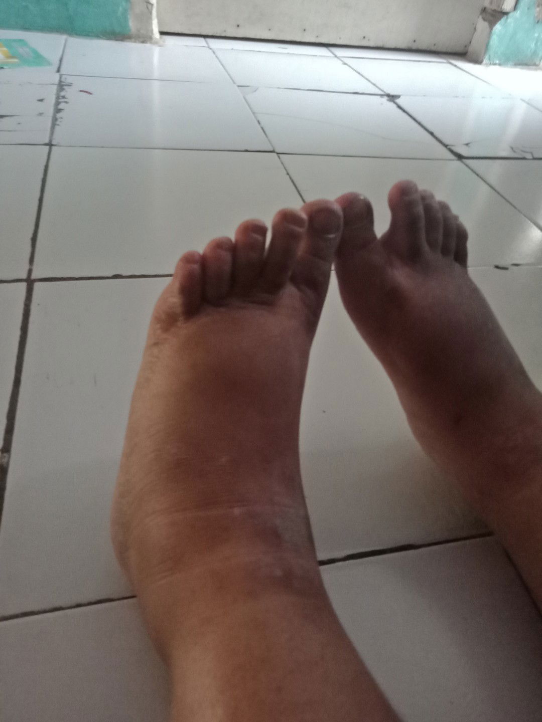 kaki bengkak d usia kehamilan trisemster 3