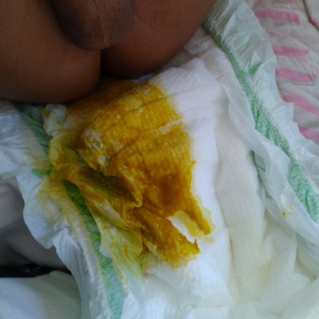 basa at parang sipon ang poop