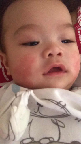 ano po kaya itong nasa muka ng baby ko
