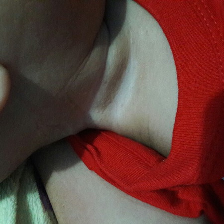 ลูกเป็นรอยขาวๆที่ข้อพับที่คอ