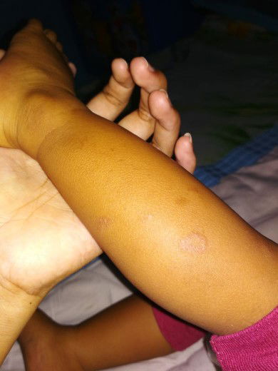 Bercak Hitam Pada Kaki