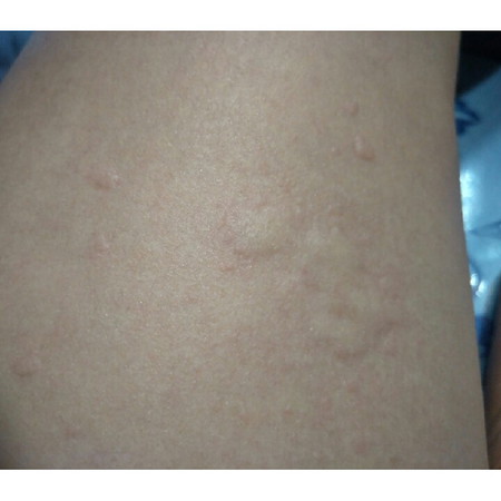 ผื่นขึ้น