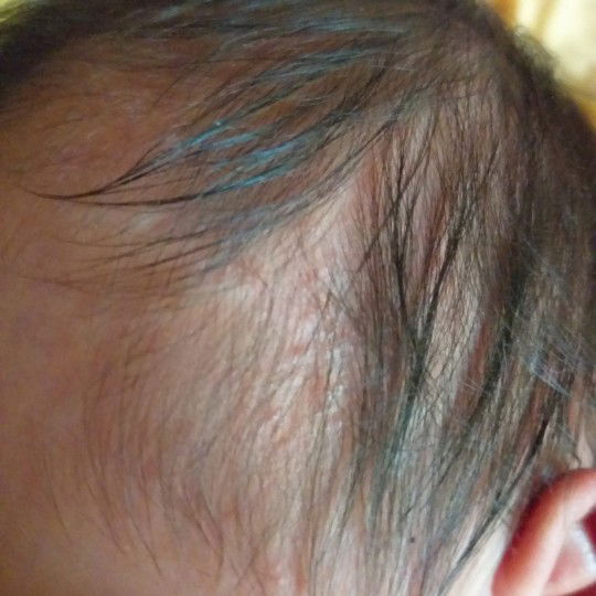 เป็นผดผื่นแบบนี้แพ้อะไรรึป่าวคะ