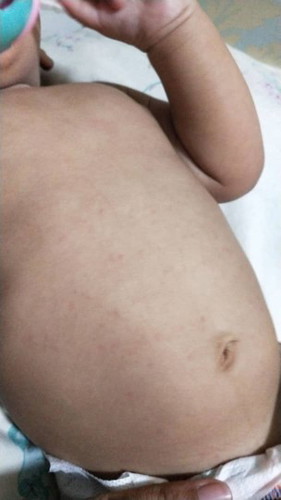 Rashes or what?