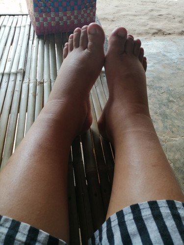 บวม