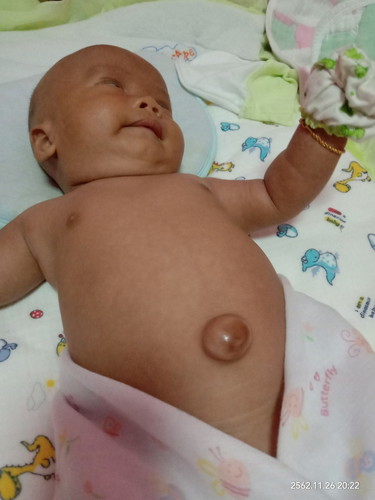 สะดือน้องพองๆออกมา