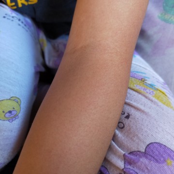 rashes