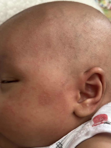 Bintik dan merah di muka bayi